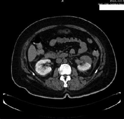 Plain Ct Scan Abdomen Showing Hypodensity In Upper Half Of Left Kidney