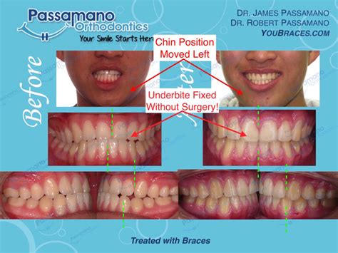 Underbite Class 3 Fixed With Braces Only No Surgery Amazing Finish