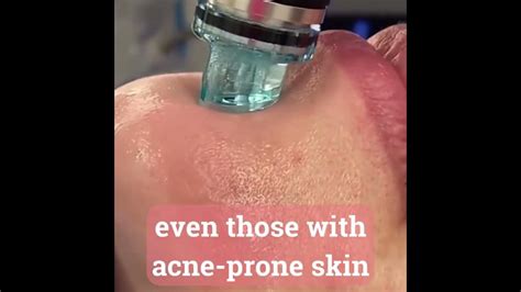 Hydrafacial For Acne Prone Skin Youtube