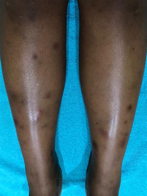 Tb And The Skin Understanding Cutaneous Forms Of Tb Dr Khoza