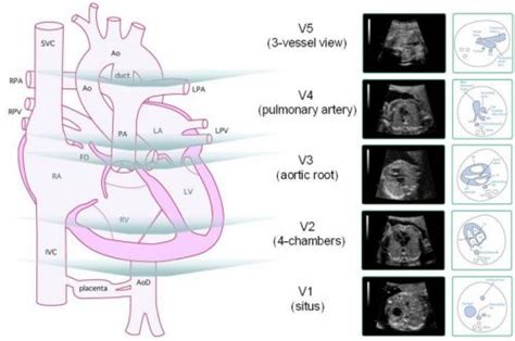 Prospective Evaluation Of The Fetal Heart Using Fetal Intelligent
