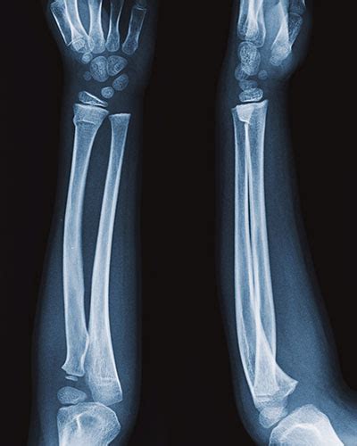 What Are Buckle Fractures Uk