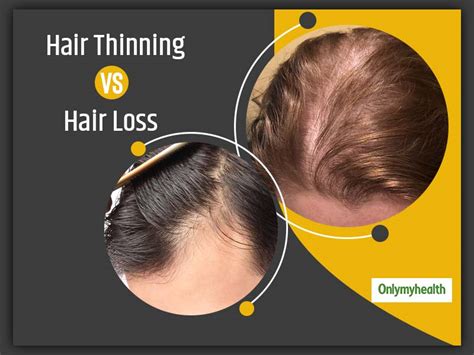 How To Differentiate Between Hair Thinning And Hair Loss Tyello