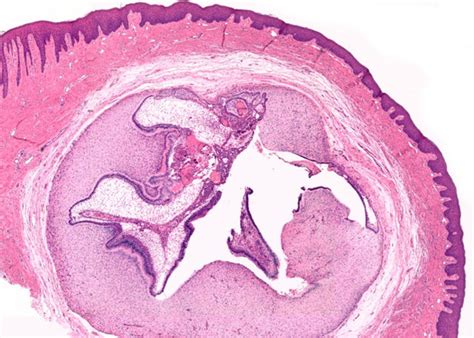 Gingival peripheral odontoma in a child: Case report of an uncommon lesion