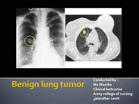 Benign Lung Tumorppt By Monikajoseph Via Authorstream Lunges Army