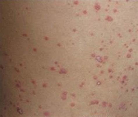 常见的疹子类型及图片过敏疹子的症状图片皮疹种类及症状图片大山谷图库