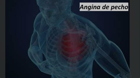 Angina De Pecho Manuel Gómez Udocz