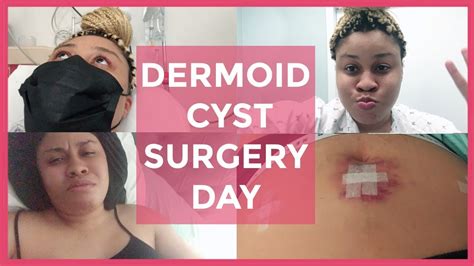 Dermoid Cyst Removal Surgery Vlog Part 2 Surgery Day My Surprise