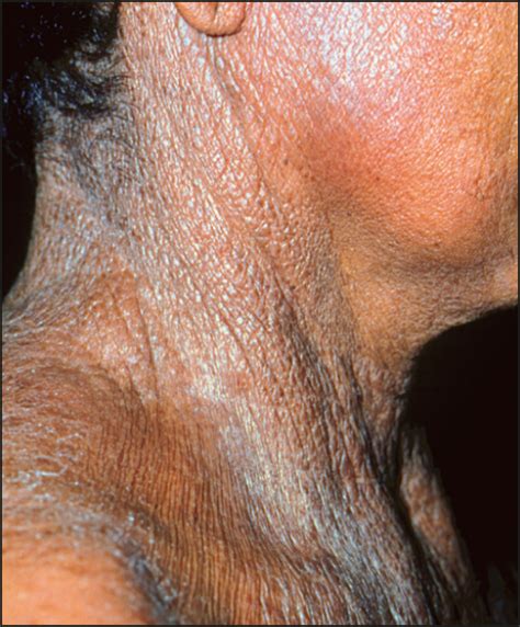 Lax Skin Masses In A 47 Year Old Woman—quiz Case Dermatology Jama