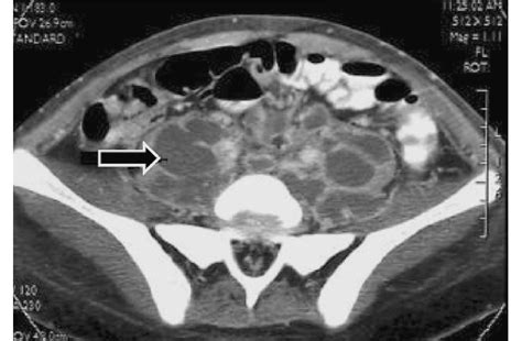 Ct Scan Demonstrating Retroperitoneal Lymph Node Involvement With