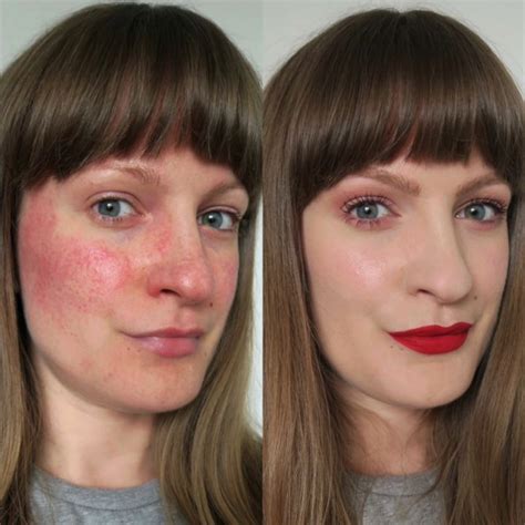 Everything Youve Ever Wanted To Know About Rosacea Ive Put Together