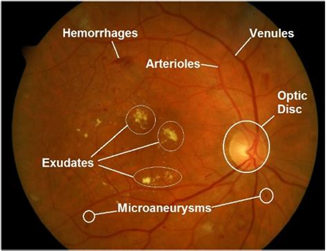 Worldwide prevalence of dr in patients with type 1 dm is 77.3% and with type 2 is 25.1%. Diabetic Retinopathy detection through integration of Deep ...