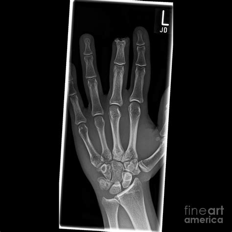 Amputated Finger X Ray Photograph By Science Photo Library Fine Art