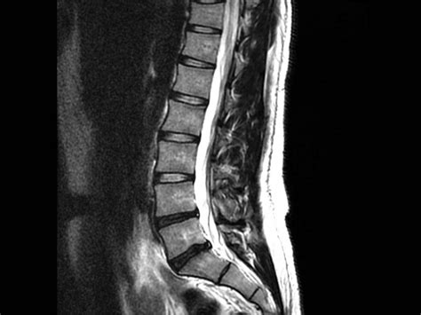 How To Read Mri Images Of Lumbar Spine Scubahooli