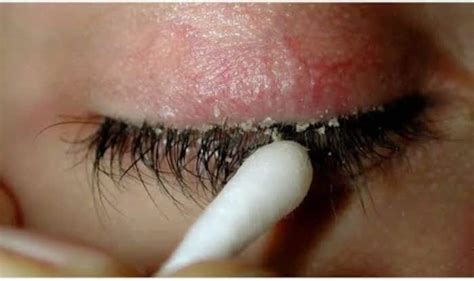 Home Remedies To Prevent Dandruff On Eyelashes And Eyebrows