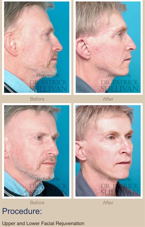 Upper And Lower Facial Rejuvenation Facial Rejuvenation Facelift