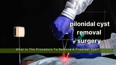 What Is The Procedure To Remove A Pilonidal Cyst