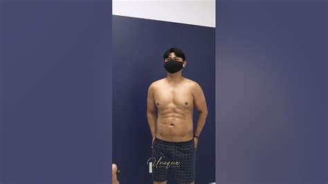 Abdominal Etching By Dr Fisher Plasticsurgery Unique Aesthetic