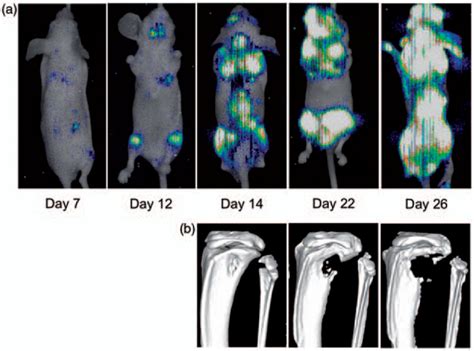 Imaging Model Of Bone Metastasis From Breast Cancer A Serial