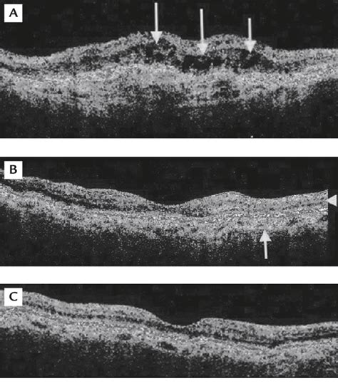 Choroidal Neovascularization Cnv Associated With Angioid Streaks