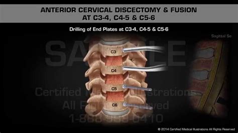 anterior cervical discectomy and fusion at c3 4 c4 5 and c5 6 music production
