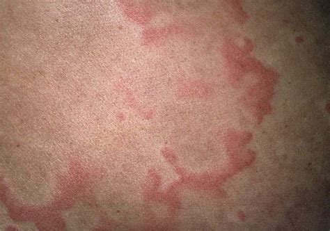 The Link Between Chronic Hives and Thyroid Disease
