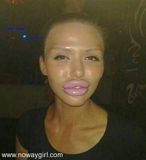 Duck Faaaaaaace Wtf Botox Lips Plastic Surgery Gone Wrong
