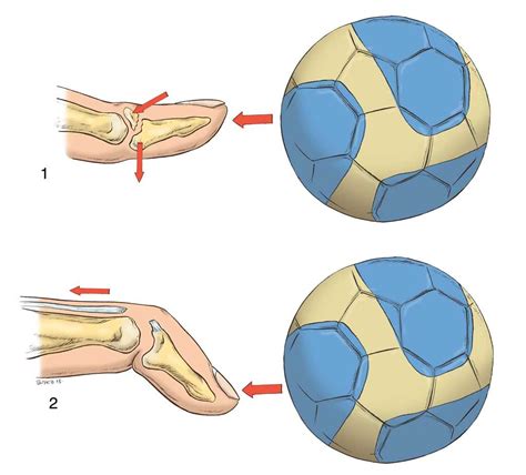 La Mainch 6 Common Ball Sports Hand Injuries