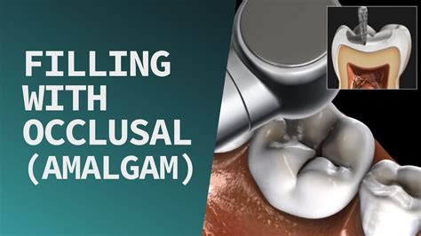Filling With Occlusal Amalgam Dental Clinic