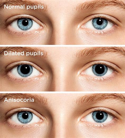 Dilated Pupils Causes And Treatment All About Vision