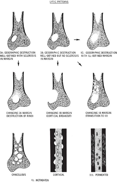 Classification Of Bone Tumors