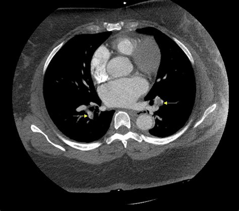 Cureus Atypical Presentation Of Pulmonary Embolism Several Months