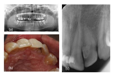 Figure Endodontic Treatment Of Type II Dens Invaginatus In A