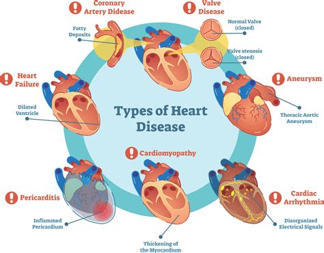 Keyword For What Are The Examples Of Coronary Heart Disease