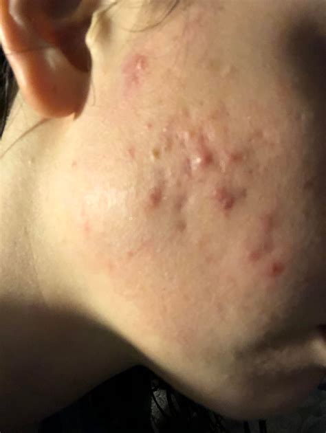 Acne Any Tips For Treating Cystic Acne On Cheeks And Forehead