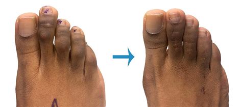 Hammer Toe Surgery Toe Straightening And Shortening Surgery Foot