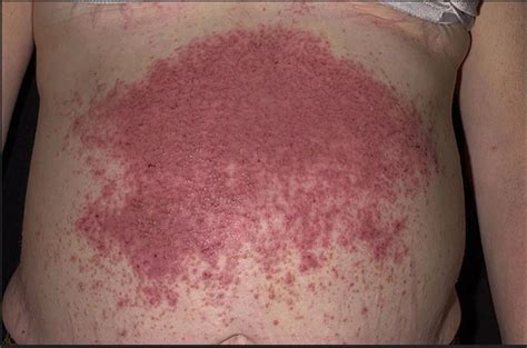 Dermatitis Herpetiformis Celiac Disease Rash Photos
