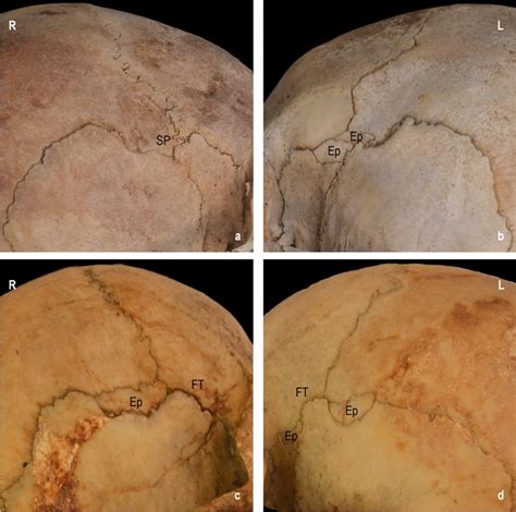 Symmetrical And Asymmetrical Distribution Of The Pterion Morphology A