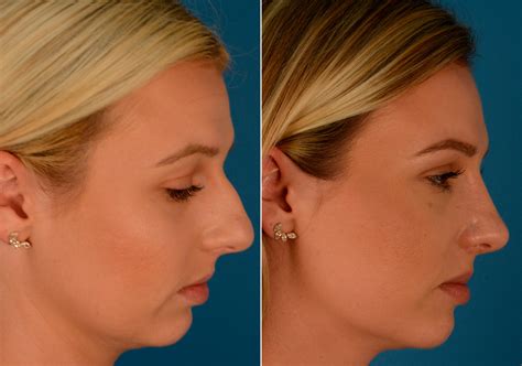 Bestof You Top Bulbous Nose Rhinoplasty Before And After In Check It Out Now