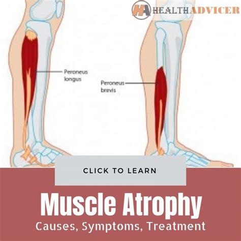 Muscle Atrophy Causes Symptoms Diagnosis And Treatment