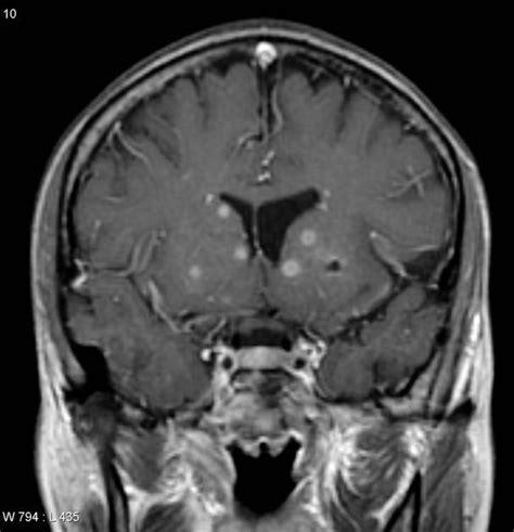 Toxoplasmosis Cerebral Radiology Case Radiology