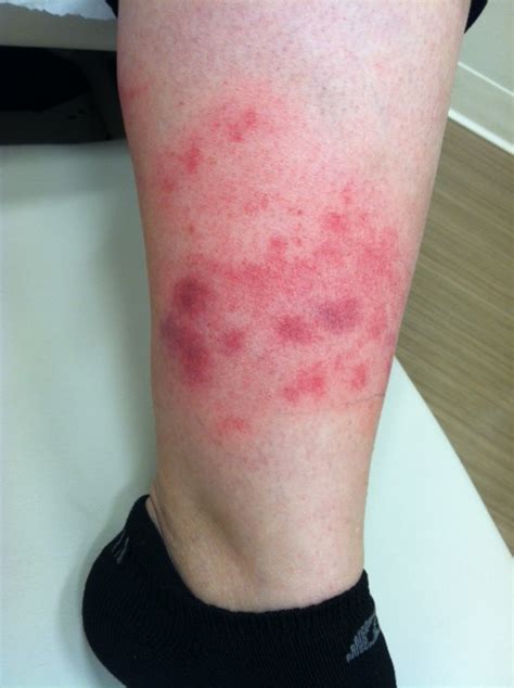 Skin Rash On Lower Leg Pictures Photos