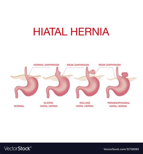 Hiatal Hernia Hiatal Hernia And Normal Anatomy Of Vector Image