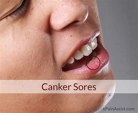 Canker Sores Or Recurrent Aphthous Stomatitis Rascausessigns