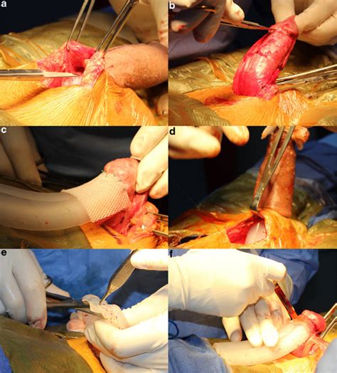 Surgical Procedure Preparation Of Implant Pocket A Everted Penis Download Scientific