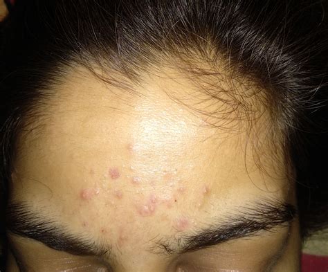 Intense Acne On Forehead And Cheeks Since Four Months General Acne