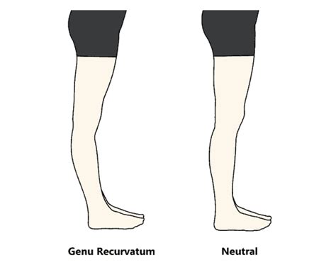 Genu Recurvatum Mississauga And Milton Chiropractor And Physiotherapy