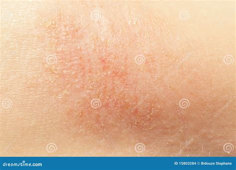Eczema On Child Skin Stock Photo Image Of Illness Healthcare 15803284