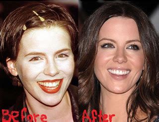 Kate Beckinsale Plastic Surgery Before and After Breast ...