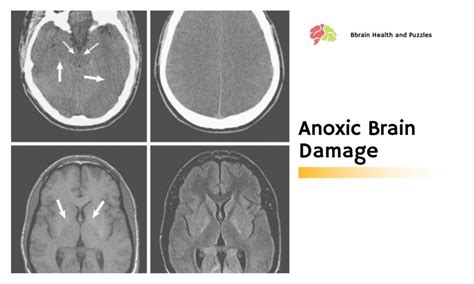 Anoxic Brain Damage Brain Health And Puzzles